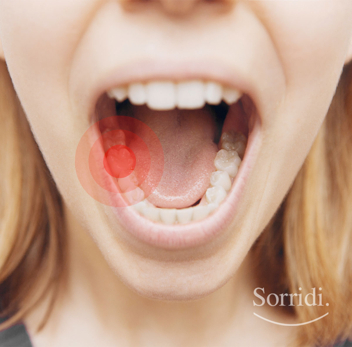 Sorridi-ch-magazine-carie-dentale-cause-e-sintomi