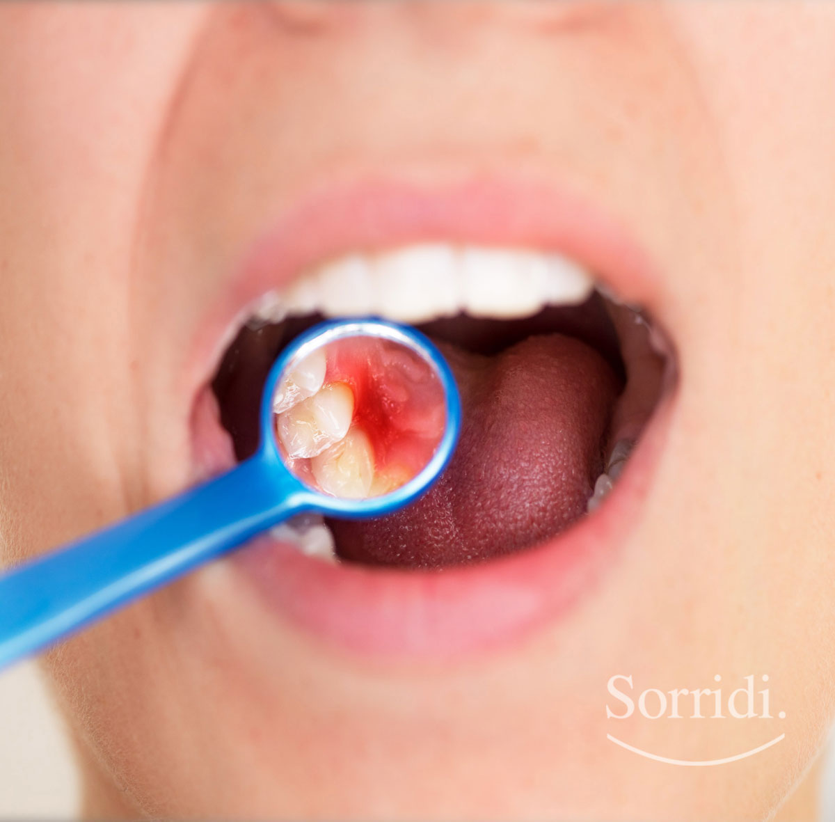 Sorridi-ch-magazine-parodontite