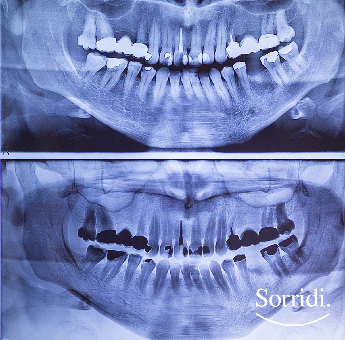 raggi-x-Sorridi-magazine-il-dentista-risponde - radiografie dentali