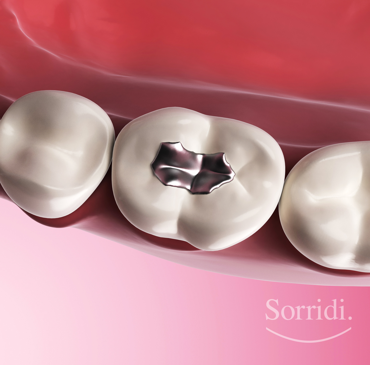 Amalgame - Dentista Locarno - Rimozione Amalgame