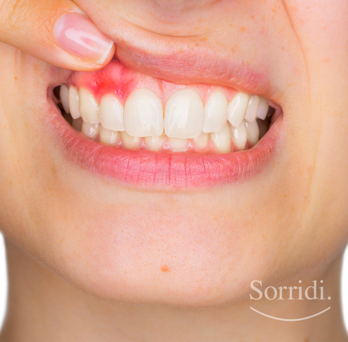 gengivite-alimentazione-sorridi-ch-magazine-dentista-locarno-studio-dott-ponchio