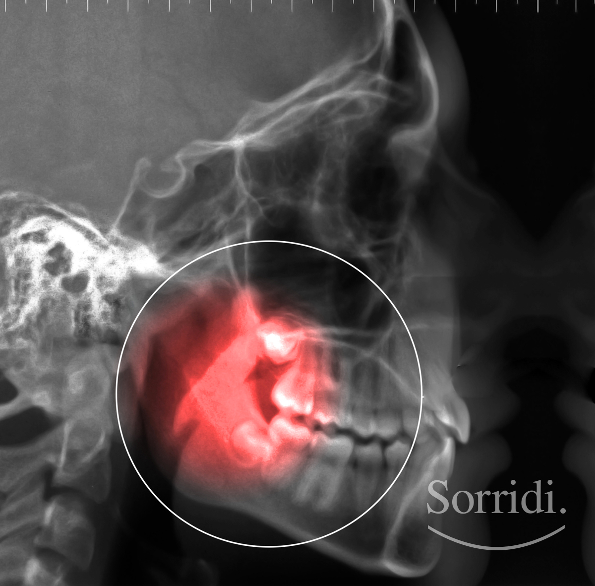 sorridi-ch-magazine-dentista-locarno-denti-del-giudizio