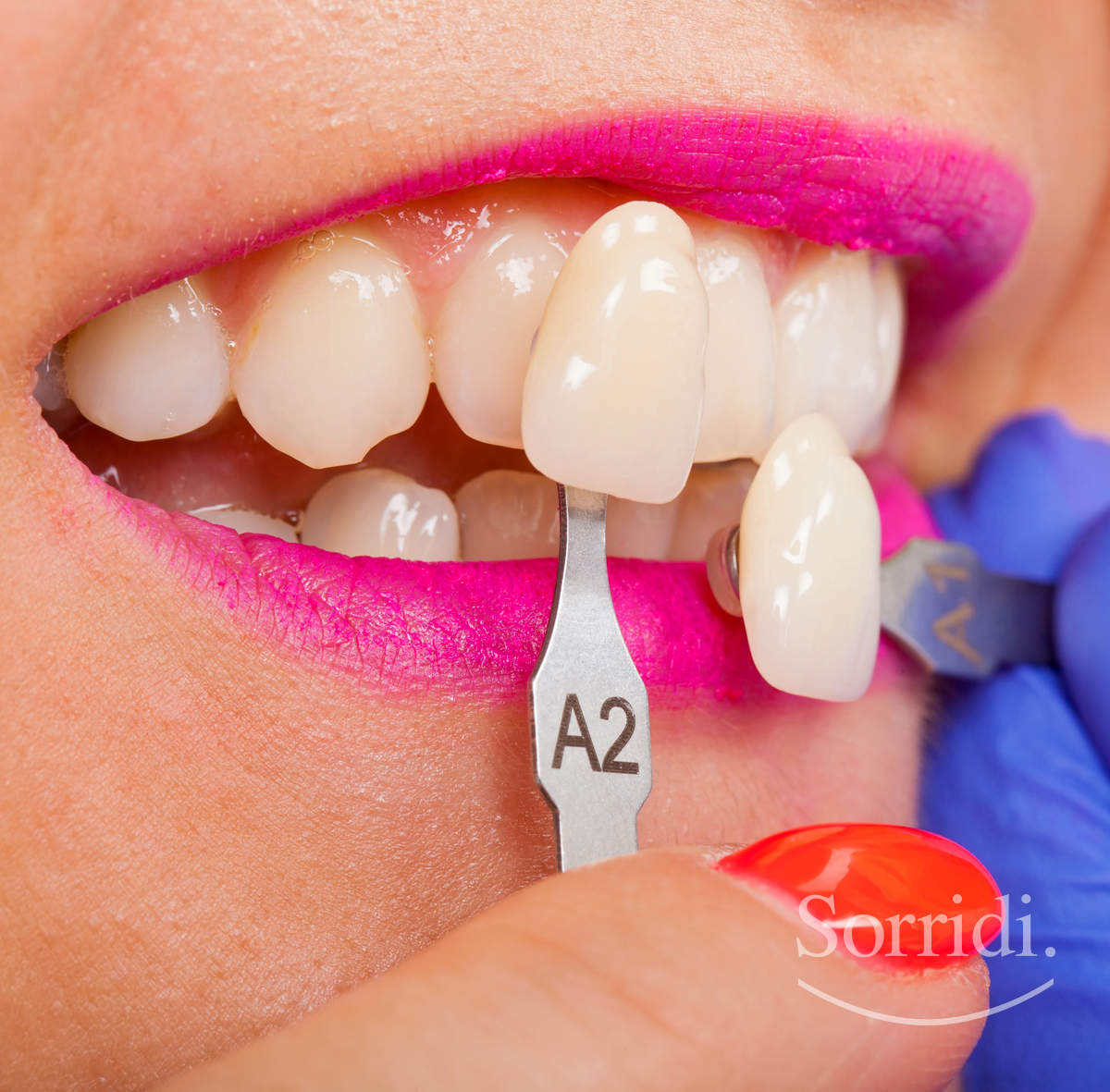 sorridi-ch-magazine-dentista-locarno-faccette-dentali