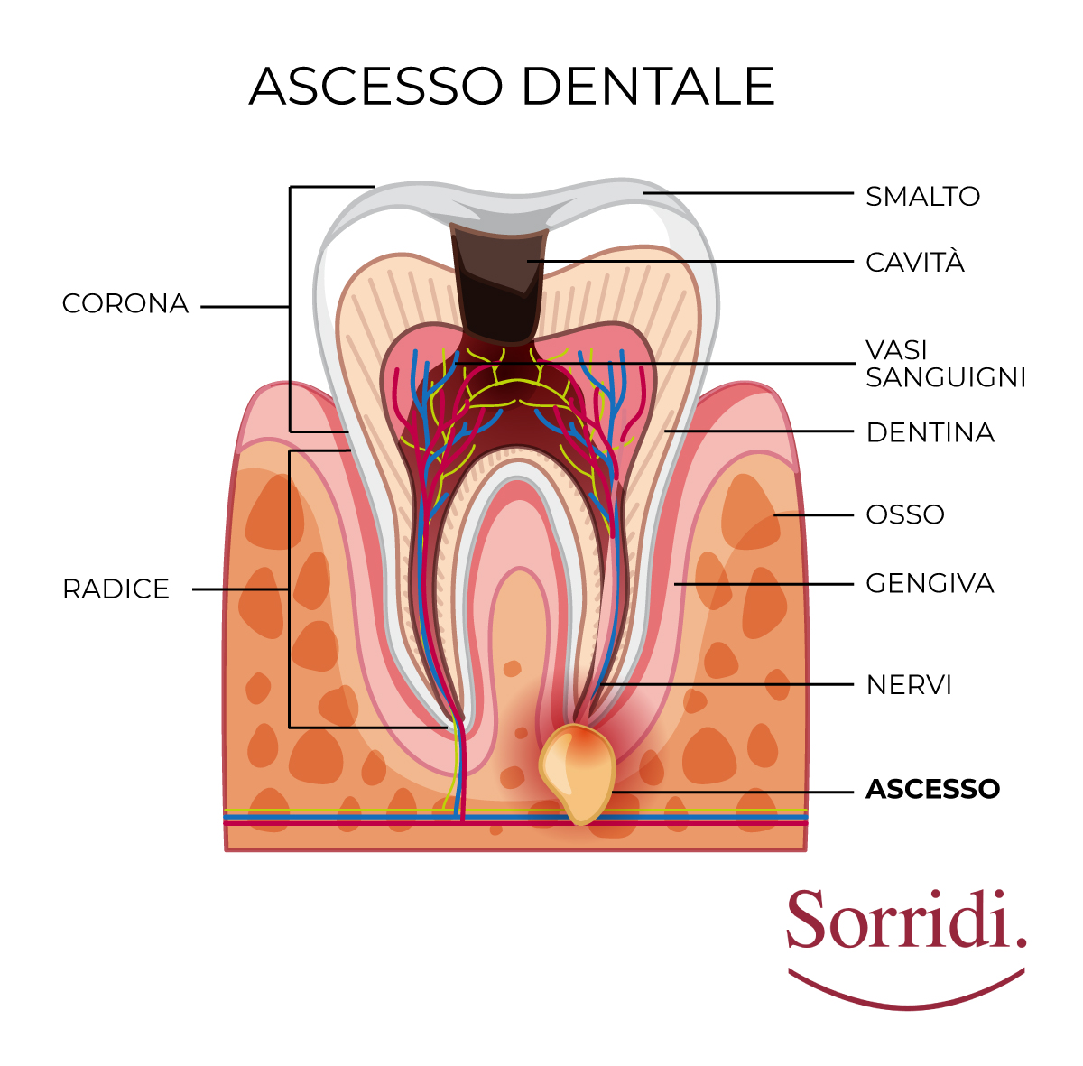 sorridi-ch-magazine-dentista-locarno-ascesso-dentale