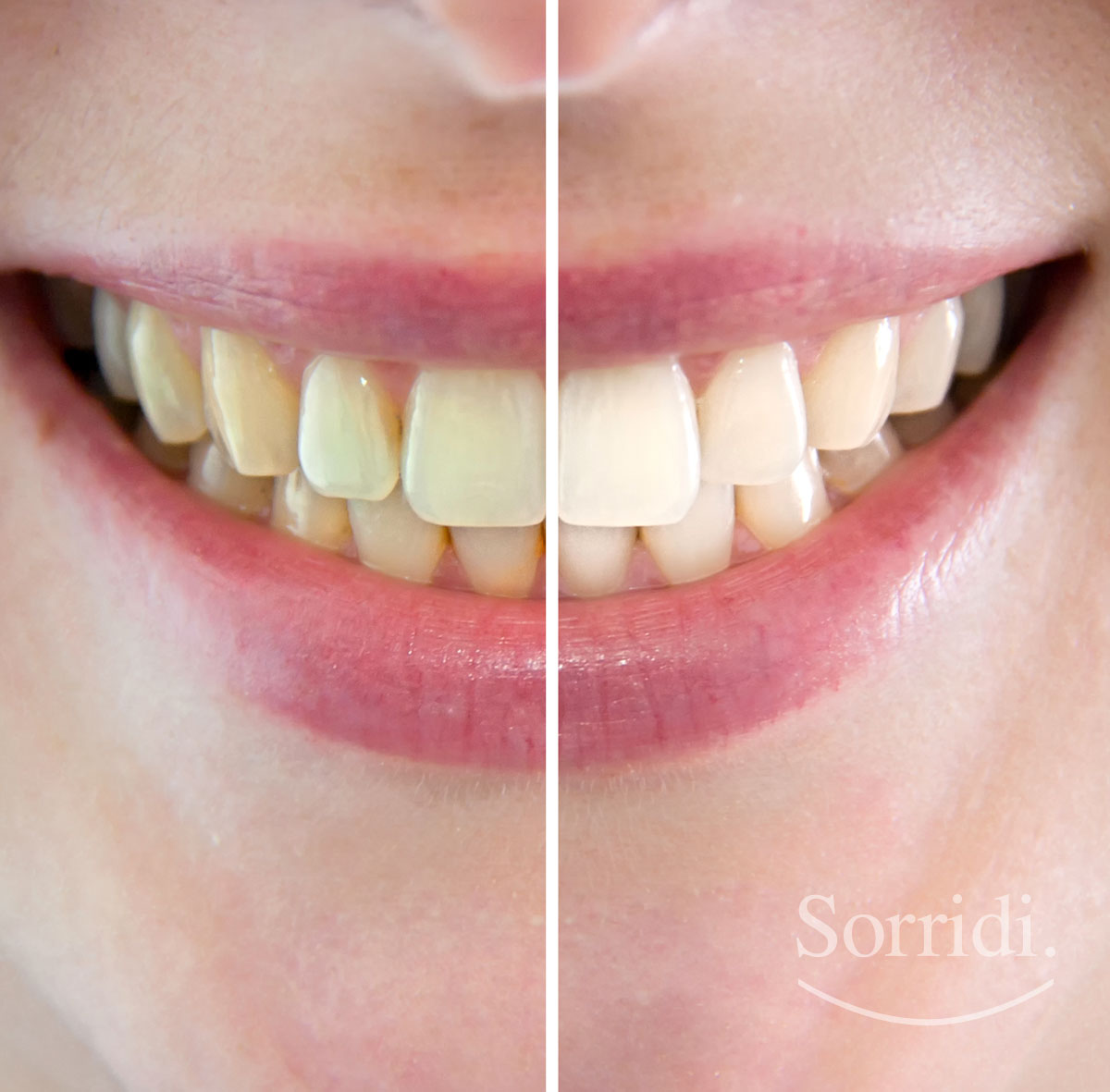 sorridi-ch-magazine-dentista-locarno-sbiancamento-denti