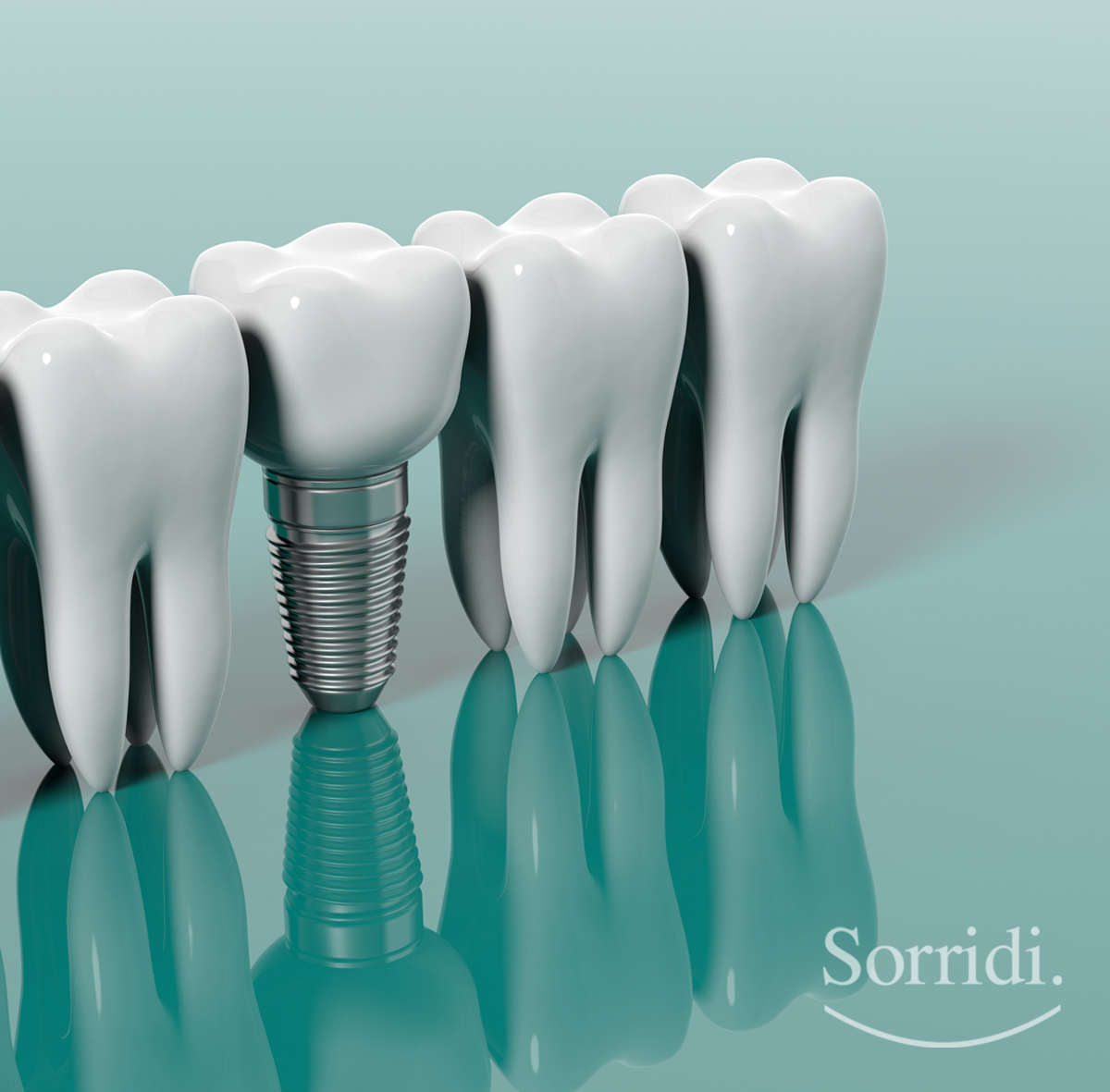 sorridi-ch-magazine-impianti-dentali