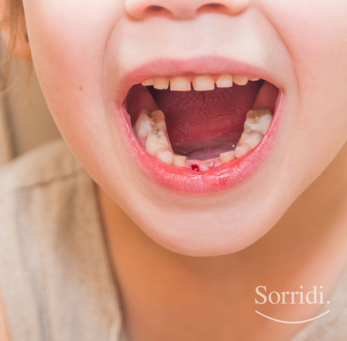 Sorridi-ch-magazine-carie-nei-bambini-e-consumo-eccessivo-di-zuccheri
