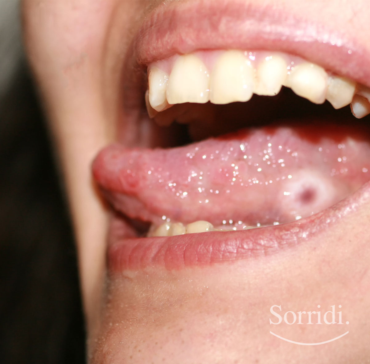 Sorridi-ch-magazine-diabete-e-parodontite