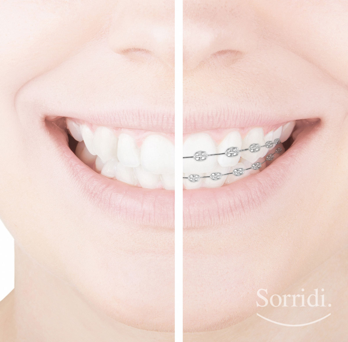 Sorridi-ch-magazine-apparecchio-dentale-invisibile-o-fisso