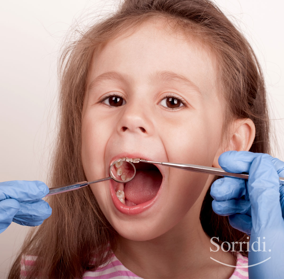 Sorridi-ch-magazine-sos-carie-bambini