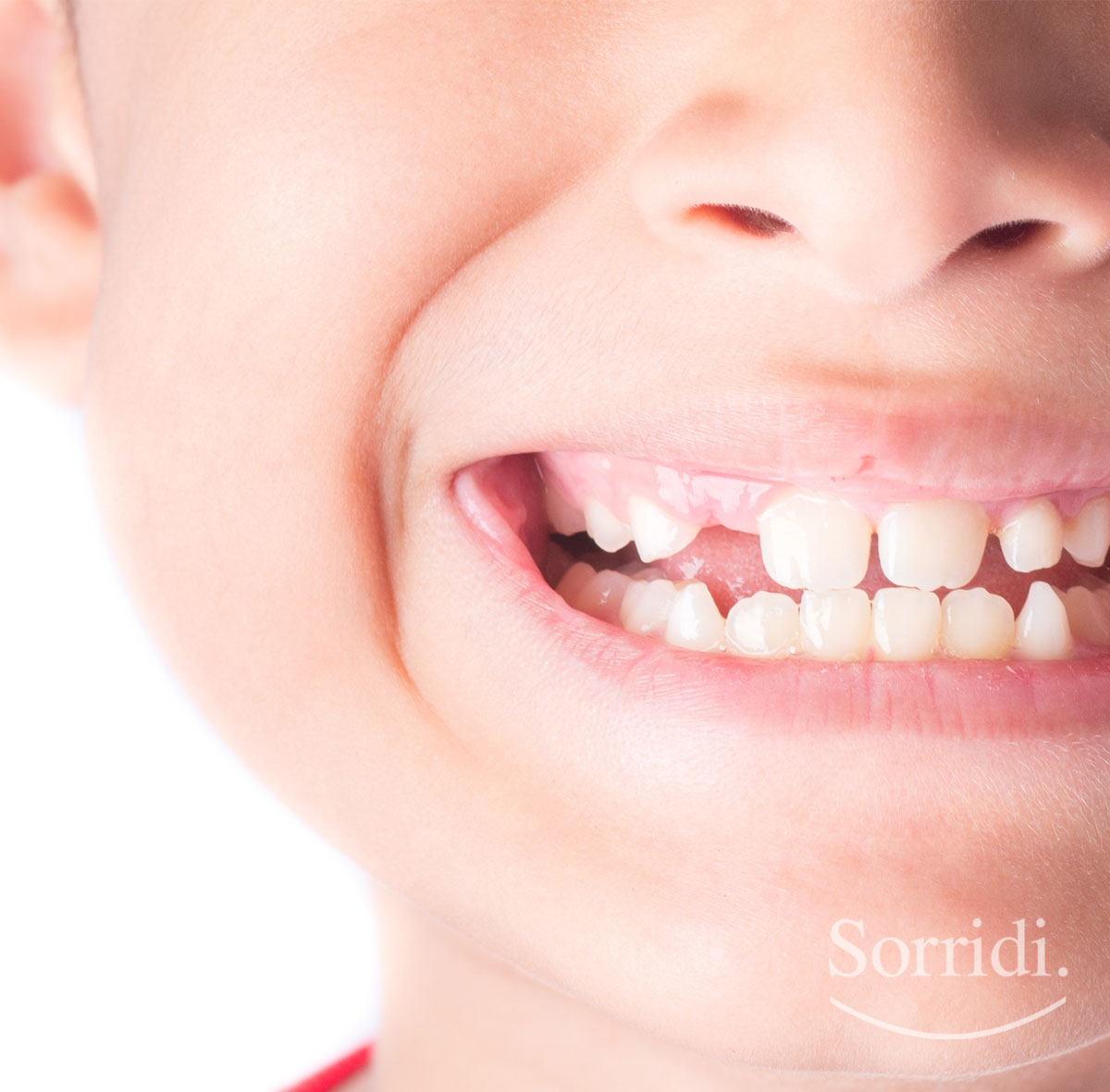 Sorridi-ch-magazine-agenesie-dentali-nei-bambini