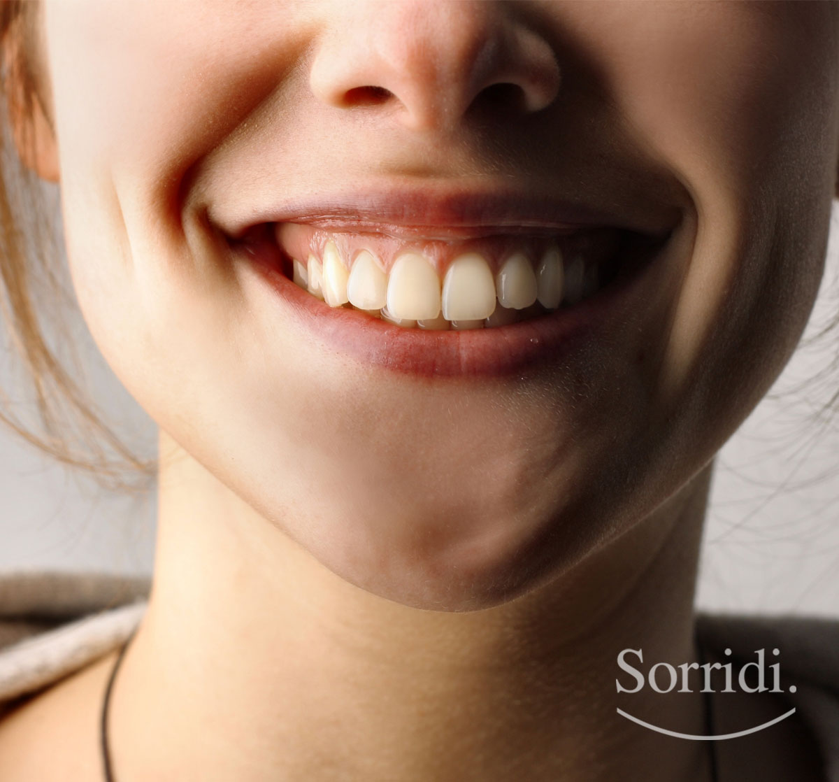 Sorridi-ch-magazine-sorriso-gengivale