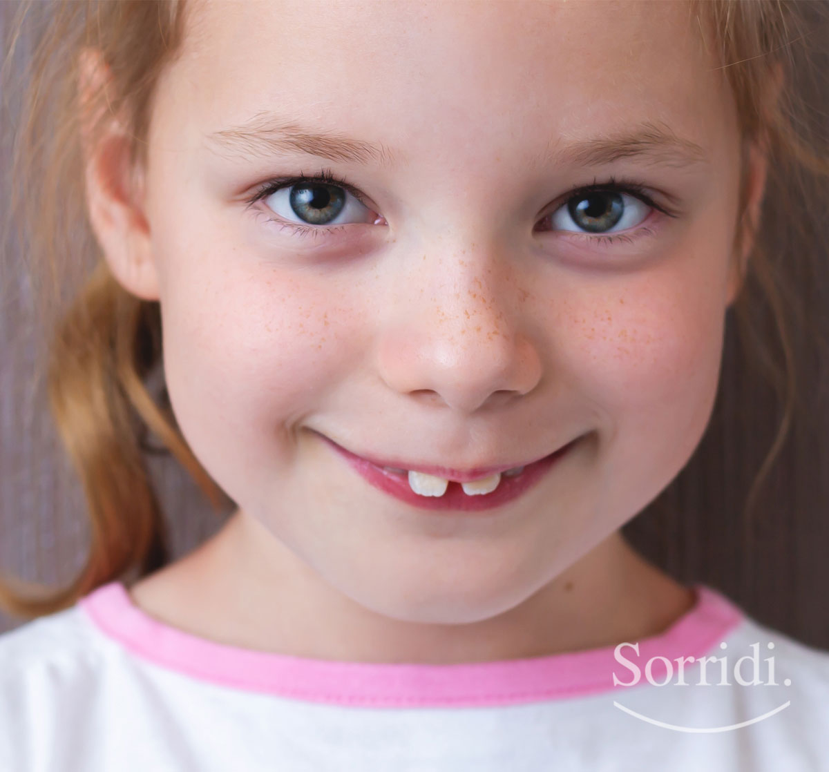 Sorridi-ch-magazine-denti-sporgenti-quello-che-devi-sapere